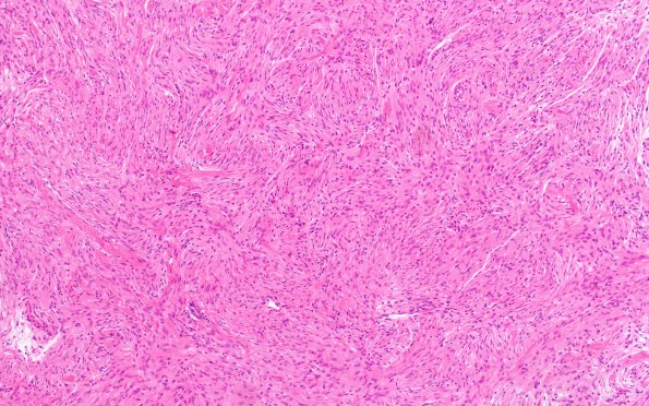 8B1 Meningioma, fibroblastic (Case 8) H&E 7