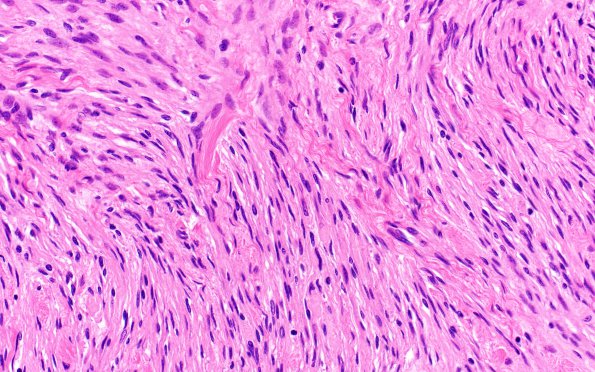 8B2 Meningioma, fibroblastic (Case 8) H&E 1