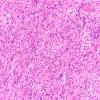 8B3 Meningioma, fibroblastic (Case 8) H&E 3