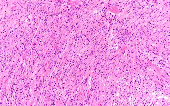 8B3 Meningioma, fibroblastic (Case 8) H&E 3