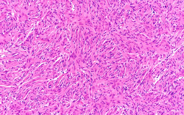 8B4 Meningioma, fibroblastic (Case 8) H&E 8