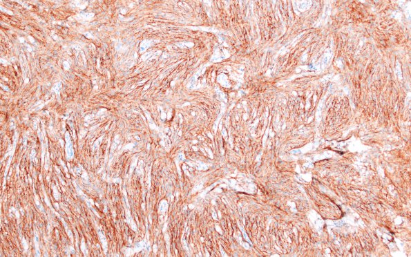 8C1 Meningioma, fibroblastic (Case 8) EMA 2