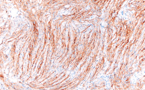 8C2 Meningioma, fibroblastic (Case 8) EMA 3