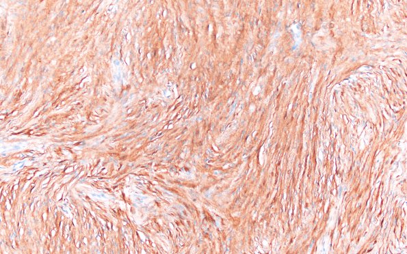 8D1 Meningioma, fibroblastic (Case 8) S100