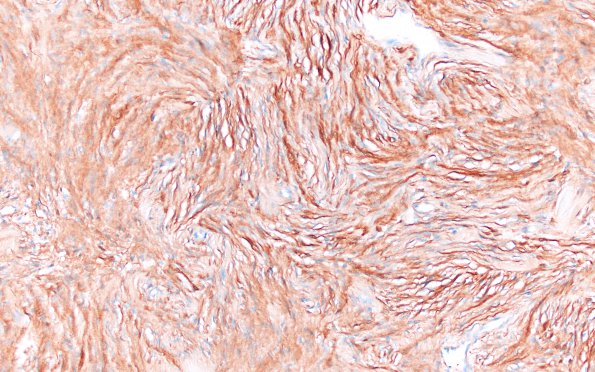 8D2 Meningioma, fibroblastic (Case 8) S100 1