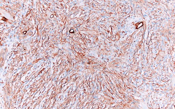 8E Meningioma, fibroblastic (Case 8) Collagen IV 2