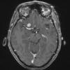 9A Meningioma, fibrous, intraventricular  (Case 9) T1W - Copy