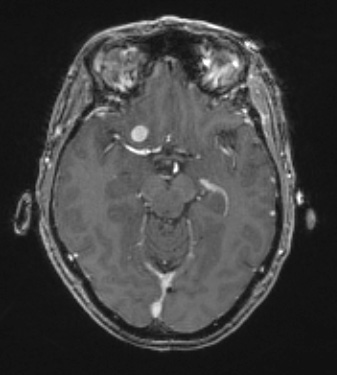 9A Meningioma, fibrous, intraventricular  (Case 9) T1W - Copy