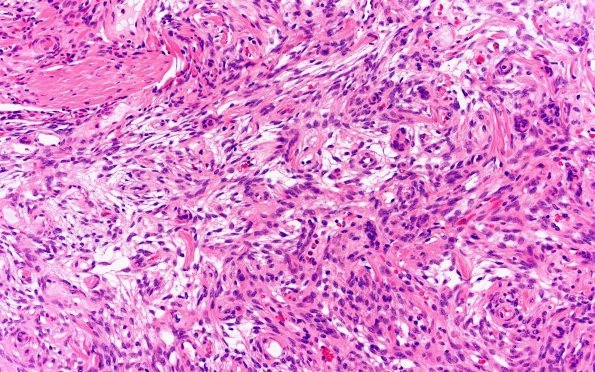 9B1 Meningioma, fibrous, intraventricular  (Case 9) H&E 20X 2