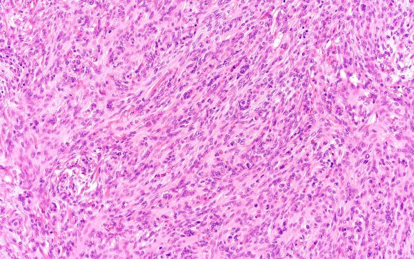 9B2 Meningioma, fibrous, intraventricular  (Case 9) H&R 20X 1