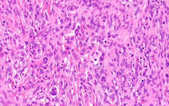 9B3 Meningioma, WHO I (Case 9) H&E 1