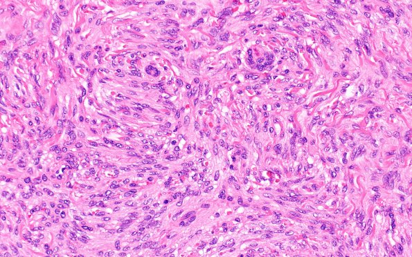 9B4 Meningioma, WHO I (Case 9) H&E 2