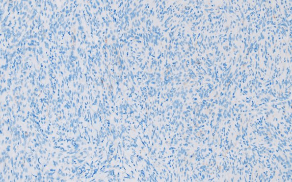 9C Meningioma, WHO I (Case 9) EMA 2