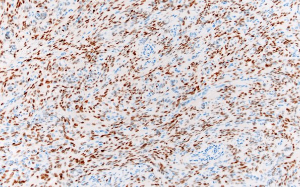 9D Meningioma, fibrous, intraventricular  (Case 9) PR 20X 2