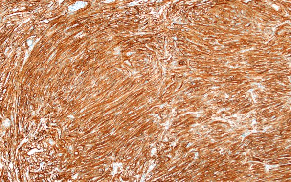 9E1 Meningioma, fibrous, intraventricular  (Case 9) SSTR2 10X