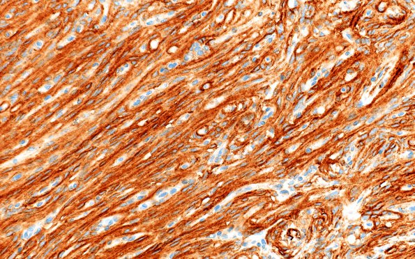 9E2 Meningioma, fibrous, intraventricular  (Case 9) SSTR2 40X