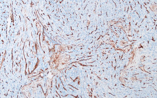 9F Meningioma, WHO I (Case 9) CD34 3