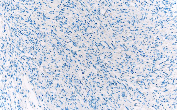 9H Meningioma, fibrous, intraventricular  (Case 9) STAT6 20X