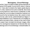 0A Meningioma - Gross Pathology