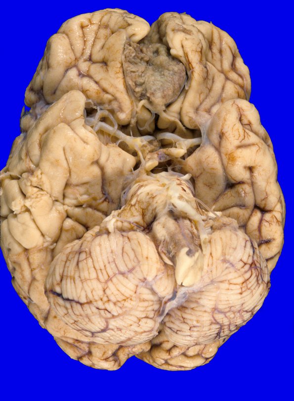 10A1 Meningioma (Case 10)