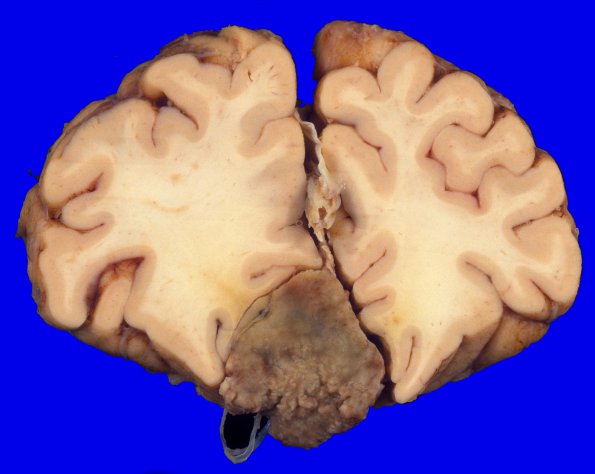 10A2 Meningioma, secretory, olfactory groove (Case 10) 1