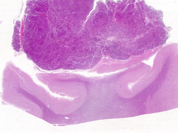 10B1 Meningioma (Case 10) H&E whole mount