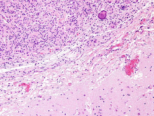 10B2 Meningioma (Case 10) H&E 10