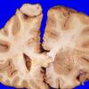 11A Meningioma (Case 11) gross 1