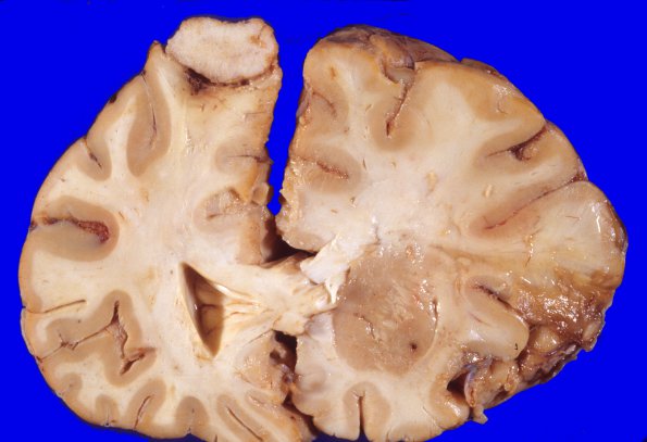 11A Meningioma (Case 11) gross 1