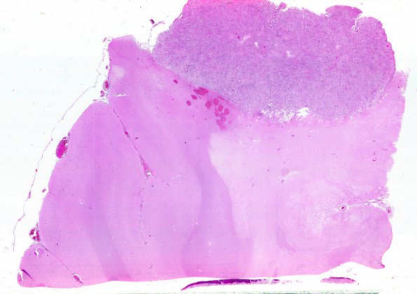 11B1 Meningioma (Case 11)