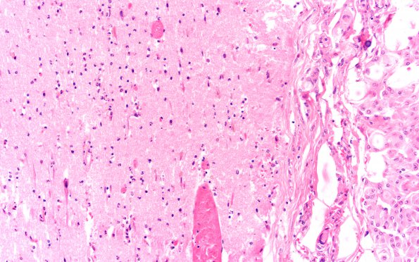 11B3 Meningioma (Case 11) 20X A H&E