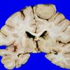 12A Meningioma (Case 12)