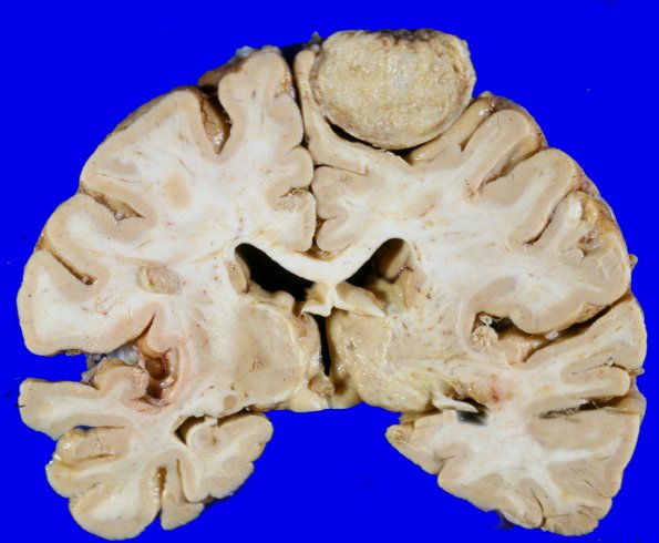 12A Meningioma (Case 12)