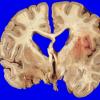 13A2 Meningioma, Anaplastic (Case 13) 9