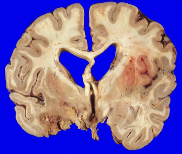 13A2 Meningioma, Anaplastic (Case 13) 9