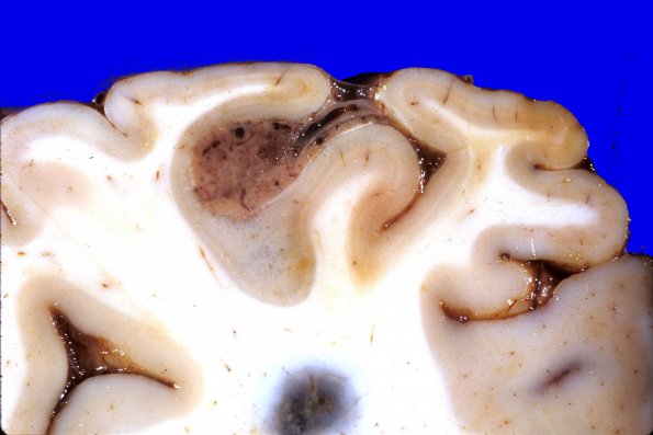 13A4 Meningioma, Anaplastic (Case 13) 4