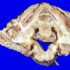 13A5 Meningioma, Anaplastic (Case 13) 3