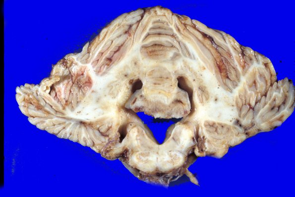 13A5 Meningioma, Anaplastic (Case 13) 3