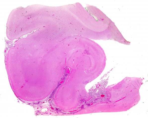 13B1 Meningioma, Anaplastic (Case 13) H&E N3 WM A