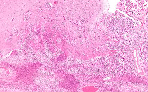 13B2 Meningioma, Anaplastic (Case 13) H&E N3 4X 2