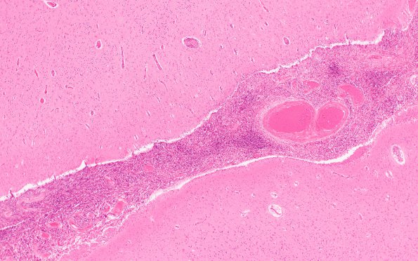 13B3 Meningioma, Anaplastic (Case 13) H&E N3 4X