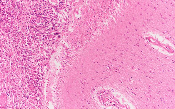 13B4 Meningioma, Anaplastic (Case 13) H&E N3 20X