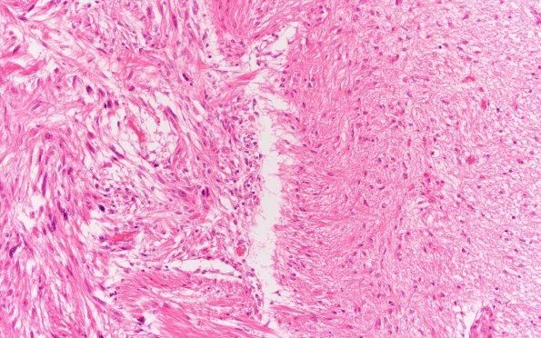 13B5 Meningioma, Anaplastic (Case 13) H&E N3 20X 2