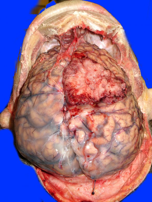 14A1 Meningioma, atypical (Case 14)_1