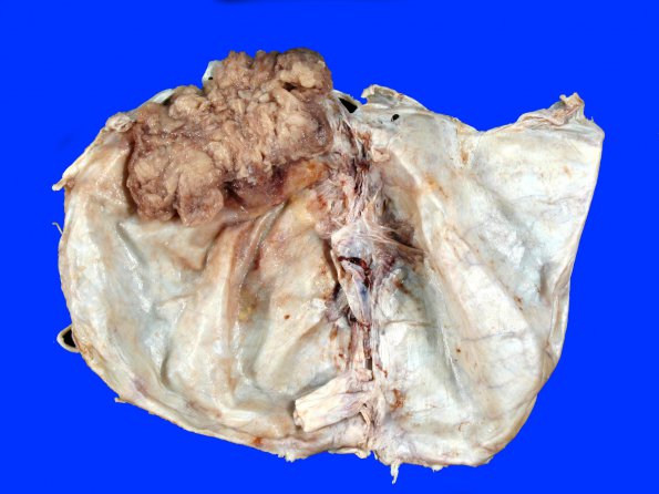 14A3 Meningioma, atypical (Case 14)_3