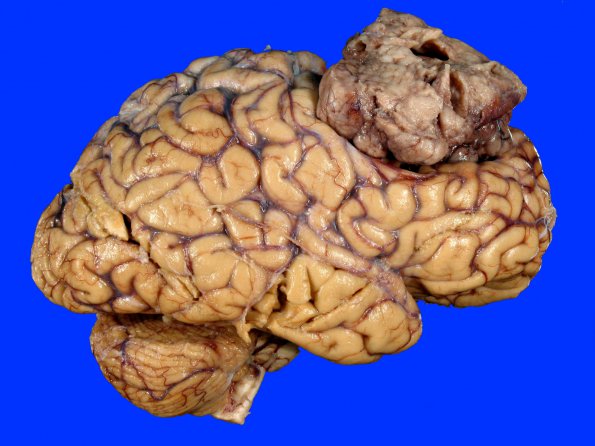 14A4 Meningioma, atypical (Case 14)_5