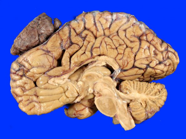 14A5 Meningioma, atypical (Case 14)_6