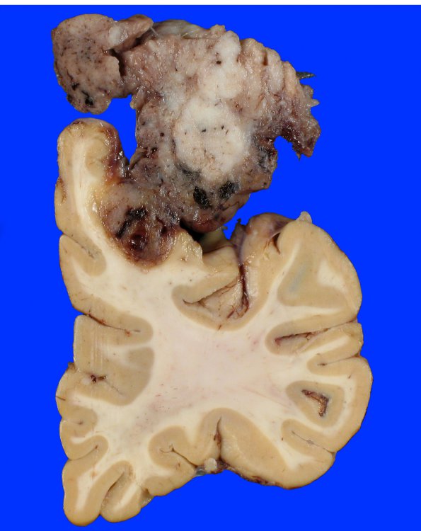 14A6 Meningioma, atypical (Case 14)_8