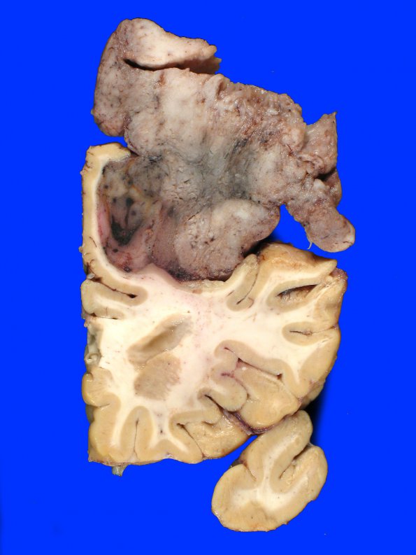 14A7 Meningioma, atypical (Case 14)_10