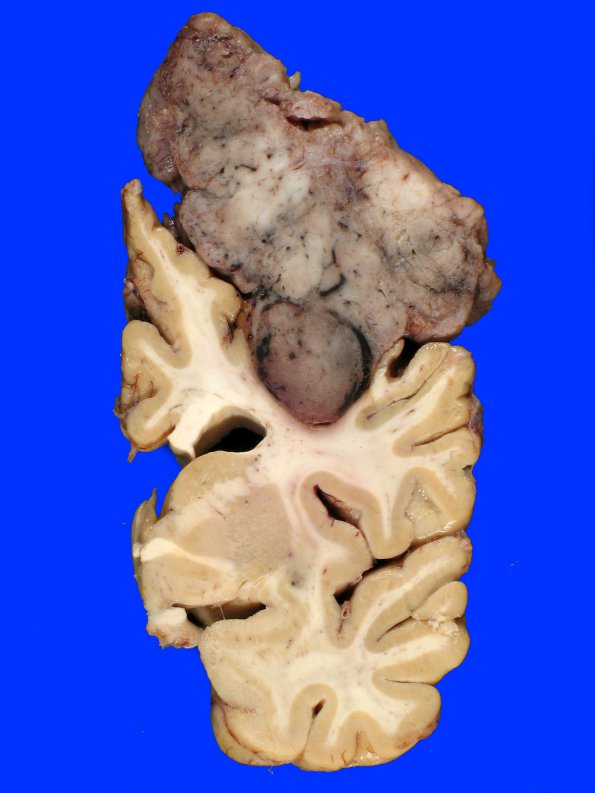 14A8 Meningioma, atypical (Case 14)_12